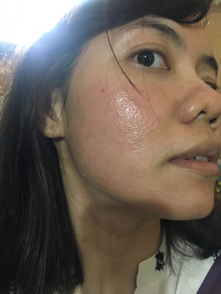 2 hours after Plasma Platelet-Rich (PRP) treatment